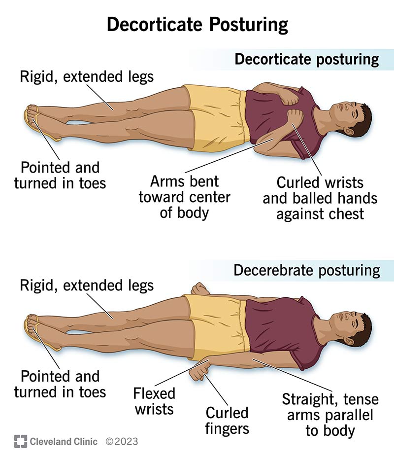 decorticate posturing        
        <figure class=